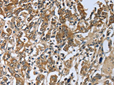 The image on the left is immunohistochemistry of paraffin-embedded Human gastic cancer tissue using CSB-PA568282(PRL Antibody) at dilution 1/50, on the right is treated with fusion protein. (Original magnification: ×200)