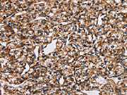 The image on the left is immunohistochemistry of paraffin-embedded Human prostate cancer tissue using CSB-PA568412(NDUFS1 Antibody) at dilution 1/35, on the right is treated with fusion protein. (Original magnification: ×200)
