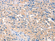 The image on the left is immunohistochemistry of paraffin-embedded Human thyroid cancer tissue using CSB-PA568434(PRPS1/2/1L1 Antibody) at dilution 1/30, on the right is treated with synthetic peptide. (Original magnification: ×200)