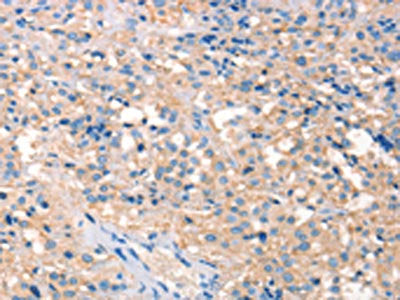 The image on the left is immunohistochemistry of paraffin-embedded Human thyroid cancer tissue using CSB-PA568434(PRPS1/2/1L1 Antibody) at dilution 1/30, on the right is treated with synthetic peptide. (Original magnification: ×200)