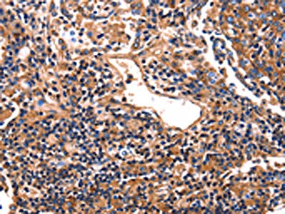 The image on the left is immunohistochemistry of paraffin-embedded Human lung cancer tissue using CSB-PA568452(HP Antibody) at dilution 1/25, on the right is treated with fusion protein. (Original magnification: ×200)