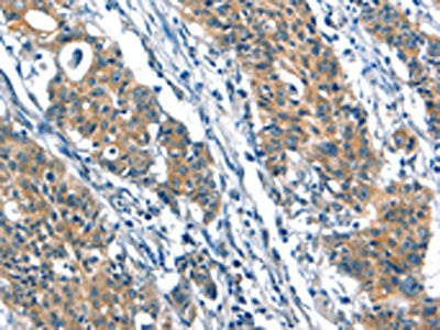 The image on the left is immunohistochemistry of paraffin-embedded Human gastic cancer tissue using CSB-PA568477(A4GALT Antibody) at dilution 1/30, on the right is treated with synthetic peptide. (Original magnification: ×200)