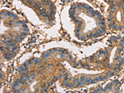 The image on the left is immunohistochemistry of paraffin-embedded Human colon cancer tissue using CSB-PA568564(HK3 Antibody) at dilution 1/40, on the right is treated with fusion protein. (Original magnification: ×200)
