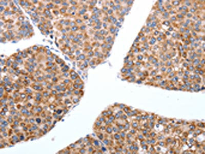 The image on the left is immunohistochemistry of paraffin-embedded Human breast cancer tissue using CSB-PA568691(MAP3K4 Antibody) at dilution 1/20, on the right is treated with synthetic peptide. (Original magnification: ×200)
