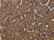 The image on the left is immunohistochemistry of paraffin-embedded Human liver cancer tissue using CSB-PA568879(LZTFL1 Antibody) at dilution 1/30, on the right is treated with fusion protein. (Original magnification: ×200)