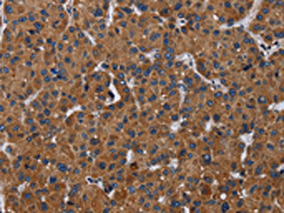 The image on the left is immunohistochemistry of paraffin-embedded Human liver cancer tissue using CSB-PA568879(LZTFL1 Antibody) at dilution 1/30, on the right is treated with fusion protein. (Original magnification: ×200)