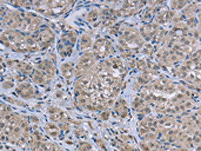 The image on the left is immunohistochemistry of paraffin-embedded Human thyroid cancer tissue using CSB-PA568889(FAR2 Antibody) at dilution 1/50, on the right is treated with fusion protein. (Original magnification: ×200)