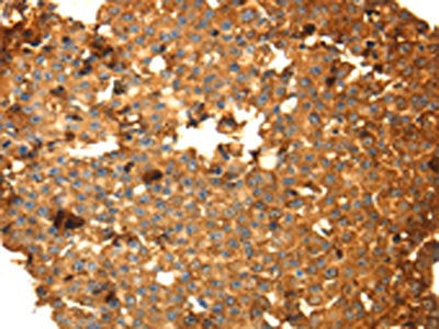 The image on the left is immunohistochemistry of paraffin-embedded Human breast cancer tissue using CSB-PA568903(DRD5 Antibody) at dilution 1/40, on the right is treated with fusion protein. (Original magnification: ×200)