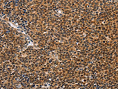 The image on the left is immunohistochemistry of paraffin-embedded Human Lymphoma tissue using CSB-PA569109(CD36 Antibody) at dilution 1/60, on the right is treated with synthetic peptide. (Original magnification: ×200)