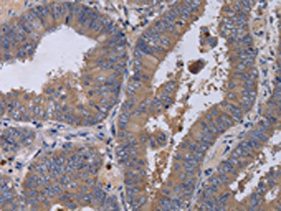 The image on the left is immunohistochemistry of paraffin-embedded Human colon cancer tissue using CSB-PA569334(MKKS Antibody) at dilution 1/50, on the right is treated with fusion protein. (Original magnification: ×200)