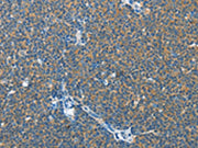 The image on the left is immunohistochemistry of paraffin-embedded Human lymphoma tissue using CSB-PA569374(IL13RA2 Antibody) at dilution 1/25, on the right is treated with fusion protein. (Original magnification: ×200)
