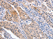 The image on the left is immunohistochemistry of paraffin-embedded Human lung cancer tissue using CSB-PA569443(CD59 Antibody) at dilution 1/30, on the right is treated with synthetic peptide. (Original magnification: ×200)