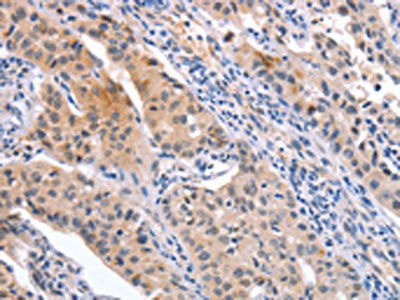 The image on the left is immunohistochemistry of paraffin-embedded Human lung cancer tissue using CSB-PA569443(CD59 Antibody) at dilution 1/30, on the right is treated with synthetic peptide. (Original magnification: ×200)