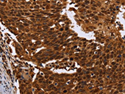 The image on the left is immunohistochemistry of paraffin-embedded Human cervical cancer tissue using CSB-PA569454(FANCF Antibody) at dilution 1/60, on the right is treated with fusion protein. (Original magnification: ×200)