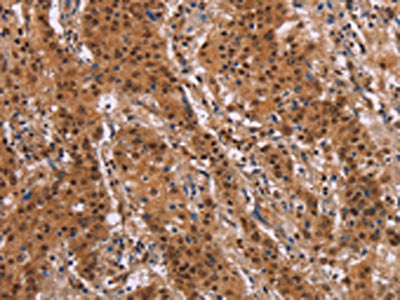 The image on the left is immunohistochemistry of paraffin-embedded Human gastric cancer tissue using CSB-PA569524(FOSL1 Antibody) at dilution 1/30, on the right is treated with synthetic peptide. (Original magnification: ×200)