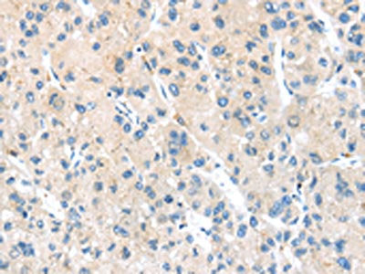 The image on the left is immunohistochemistry of paraffin-embedded Human liver cancer tissue using CSB-PA569584(HSD11B2 Antibody) at dilution 1/20, on the right is treated with synthetic peptide. (Original magnification: ×200)