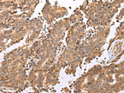 The image on the left is immunohistochemistry of paraffin-embedded Human prostate cancer tissue using CSB-PA569709(UQCRC2 Antibody) at dilution 1/25, on the right is treated with fusion protein. (Original magnification: ×200)