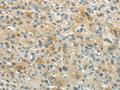 The image on the left is immunohistochemistry of paraffin-embedded Human liver cancer tissue using CSB-PA569780(XKR3 Antibody) at dilution 1/20, on the right is treated with synthetic peptide. (Original magnification: ×200)