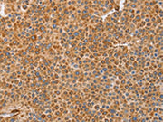 The image on the left is immunohistochemistry of paraffin-embedded Human liver cancer tissue using CSB-PA569791(BRS3 Antibody) at dilution 1/30, on the right is treated with synthetic peptide. (Original magnification: ×200)