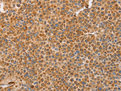 The image on the left is immunohistochemistry of paraffin-embedded Human liver cancer tissue using CSB-PA569791(BRS3 Antibody) at dilution 1/30, on the right is treated with synthetic peptide. (Original magnification: ×200)