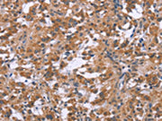 The image on the left is immunohistochemistry of paraffin-embedded Human thyroid cancer tissue using CSB-PA569859(GNPAT Antibody) at dilution 1/40, on the right is treated with synthetic peptide. (Original magnification: ×200)