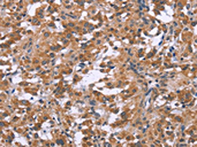 The image on the left is immunohistochemistry of paraffin-embedded Human thyroid cancer tissue using CSB-PA569859(GNPAT Antibody) at dilution 1/40, on the right is treated with synthetic peptide. (Original magnification: ×200)