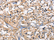 The image on the left is immunohistochemistry of paraffin-embedded Human thyroid cancer tissue using CSB-PA569917(CAPZA2 Antibody) at dilution 1/15, on the right is treated with fusion protein. (Original magnification: ×200)