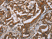 The image on the left is immunohistochemistry of paraffin-embedded Human liver cancer tissue using CSB-PA569970(PLXNB1 Antibody) at dilution 1/50, on the right is treated with synthetic peptide. (Original magnification: ×200)