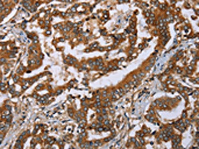 The image on the left is immunohistochemistry of paraffin-embedded Human liver cancer tissue using CSB-PA569970(PLXNB1 Antibody) at dilution 1/50, on the right is treated with synthetic peptide. (Original magnification: ×200)