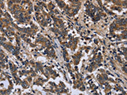 The image is immunohistochemistry of paraffin-embedded Human liver cancer tissue using CSB-PA570140(FRK Antibody) at dilution 1/50. (Original magnification: ×200)