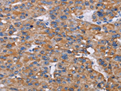 The image on the left is immunohistochemistry of paraffin-embedded Human liver cancer tissue using CSB-PA570196(NIT1 Antibody) at dilution 1/50, on the right is treated with fusion protein. (Original magnification: ×200)
