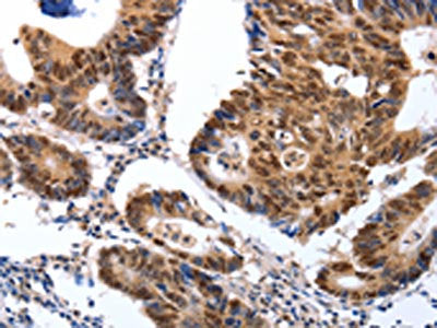 The image on the left is immunohistochemistry of paraffin-embedded Human colon cancer tissue using CSB-PA570222(MAP2K1 Antibody) at dilution 1/25, on the right is treated with synthetic peptide. (Original magnification: ×200)