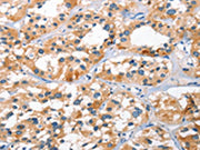 The image on the left is immunohistochemistry of paraffin-embedded Human thyroid cancer tissue using CSB-PA570255(BNIP3L Antibody) at dilution 1/40, on the right is treated with synthetic peptide. (Original magnification: ×200)