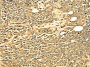 The image on the left is immunohistochemistry of paraffin-embedded Human ovarian cancer tissue using CSB-PA570366(ECE2 Antibody) at dilution 1/25, on the right is treated with fusion protein. (Original magnification: ×200)