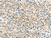 The image on the left is immunohistochemistry of paraffin-embedded Human prostate cancer tissue using CSB-PA570383(TTI1 Antibody) at dilution 1/40, on the right is treated with synthetic peptide. (Original magnification: ×200)