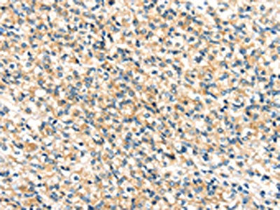 The image on the left is immunohistochemistry of paraffin-embedded Human prostate cancer tissue using CSB-PA570383(TTI1 Antibody) at dilution 1/40, on the right is treated with synthetic peptide. (Original magnification: ×200)