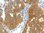 The image on the left is immunohistochemistry of paraffin-embedded Human ovarian cancer tissue using CSB-PA570456(SCN9A Antibody) at dilution 1/40, on the right is treated with synthetic peptide. (Original magnification: ×200)