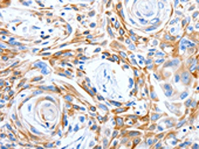 The image on the left is immunohistochemistry of paraffin-embedded Human esophagus cancer tissue using CSB-PA570494(LRIG3 Antibody) at dilution 1/50, on the right is treated with synthetic peptide. (Original magnification: ×200)