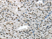 The image on the left is immunohistochemistry of paraffin-embedded Human breast cancer tissue using CSB-PA570820(TKT Antibody) at dilution 1/25, on the right is treated with fusion protein. (Original magnification: ×200)