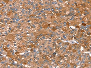 The image on the left is immunohistochemistry of paraffin-embedded Human liver cancer tissue using CSB-PA570897(REC8 Antibody) at dilution 1/25, on the right is treated with fusion protein. (Original magnification: ×200)