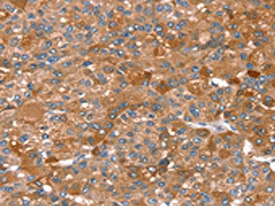 The image on the left is immunohistochemistry of paraffin-embedded Human liver cancer tissue using CSB-PA570897(REC8 Antibody) at dilution 1/25, on the right is treated with fusion protein. (Original magnification: ×200)
