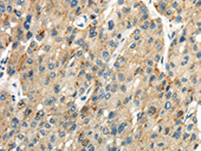The image on the left is immunohistochemistry of paraffin-embedded Human liver cancer tissue using CSB-PA571004(CLDN19 Antibody) at dilution 1/35, on the right is treated with synthetic peptide. (Original magnification: ×200)