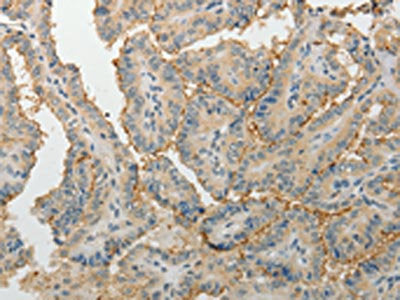 The image on the left is immunohistochemistry of paraffin-embedded Human thyroid cancer tissue using CSB-PA571057(MPZ Antibody) at dilution 1/5, on the right is treated with fusion protein. (Original magnification: ×200)