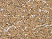 The image on the left is immunohistochemistry of paraffin-embedded Human liver cancer tissue using CSB-PA571155(SMC6 Antibody) at dilution 1/30, on the right is treated with synthetic peptide. (Original magnification: ×200)