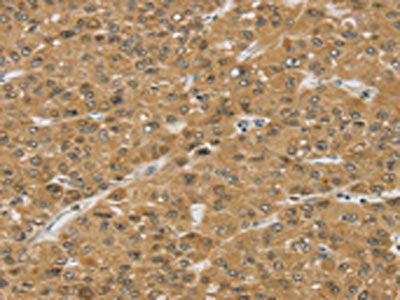 The image on the left is immunohistochemistry of paraffin-embedded Human liver cancer tissue using CSB-PA571155(SMC6 Antibody) at dilution 1/30, on the right is treated with synthetic peptide. (Original magnification: ×200)