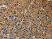 The image on the left is immunohistochemistry of paraffin-embedded Human liver cancer tissue using CSB-PA571416(DUSP23 Antibody) at dilution 1/30, on the right is treated with fusion protein. (Original magnification: ×200)