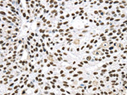 The image on the left is immunohistochemistry of paraffin-embedded Human breast cancer tissue using CSB-PA571464(DDX39B Antibody) at dilution 1/40, on the right is treated with synthetic peptide. (Original magnification: ×200)