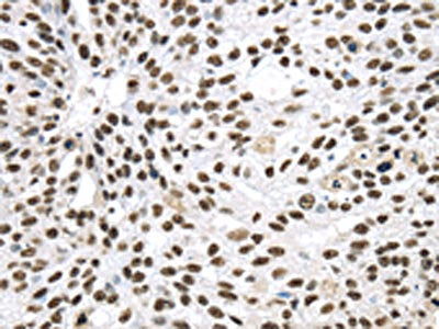 The image on the left is immunohistochemistry of paraffin-embedded Human breast cancer tissue using CSB-PA571464(DDX39B Antibody) at dilution 1/40, on the right is treated with synthetic peptide. (Original magnification: ×200)