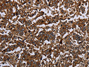The image on the left is immunohistochemistry of paraffin-embedded Human liver cancer tissue using CSB-PA571650(HOMER2 Antibody) at dilution 1/30, on the right is treated with fusion protein. (Original magnification: ×200)