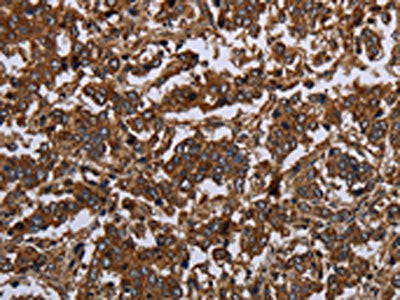 The image on the left is immunohistochemistry of paraffin-embedded Human liver cancer tissue using CSB-PA571650(HOMER2 Antibody) at dilution 1/30, on the right is treated with fusion protein. (Original magnification: ×200)